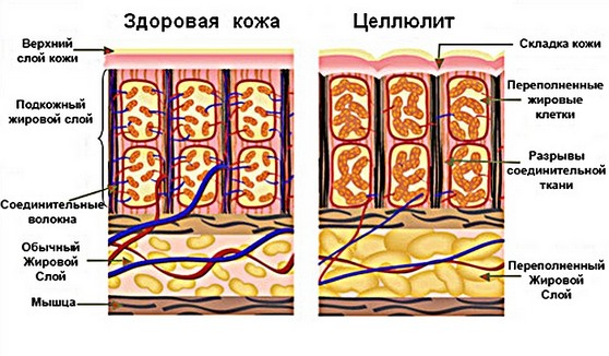 Избавляемся от "апельсиновой корки" в домашних условиях